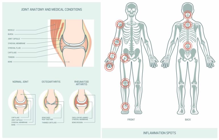 what is arthritis