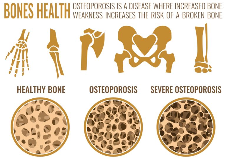 what is Osteoporosis