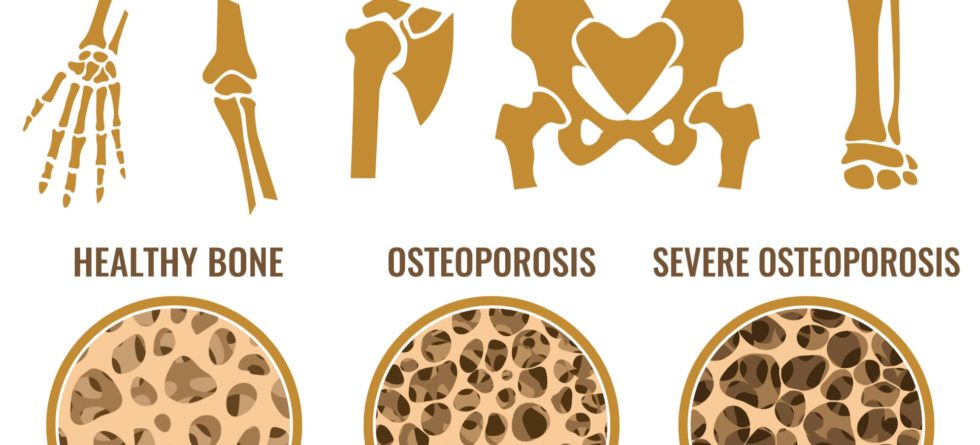 what is Osteoporosis