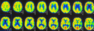 Positron Emission Tomography Test