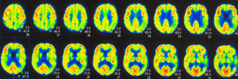 Positron Emission Tomography Test