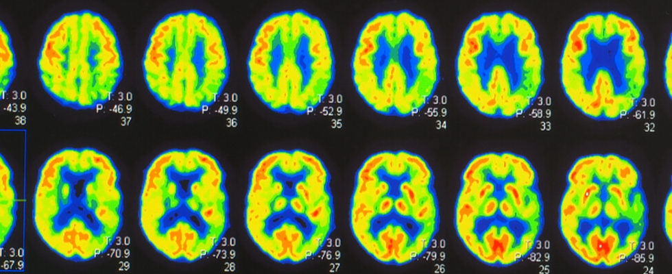 Positron Emission Tomography Test