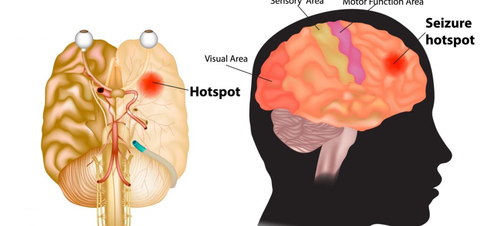 can alzheimers cause seizures